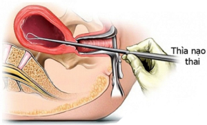 nhung bieu hien thuong gap sau khi nao hut thai