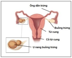 U nang buong trung - nguyen nhan va tac hai
