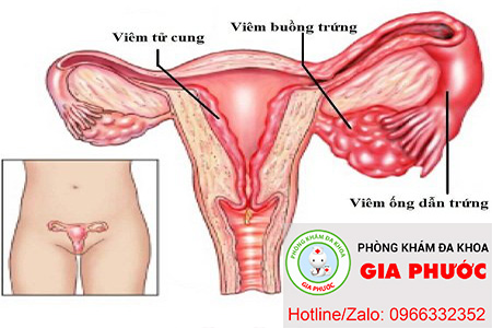 viem nhiem cac vung lan can lay lan sang viem buong trưng