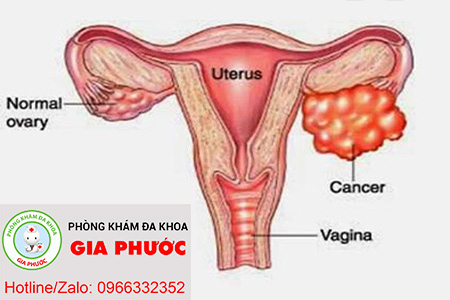 viem buong trung la nguy co dan den ung thu buong trung