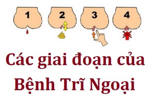 Cac giai doan benh tri ngoai