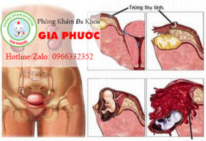 viem vung chau nguyen nhan va cach phong ngua