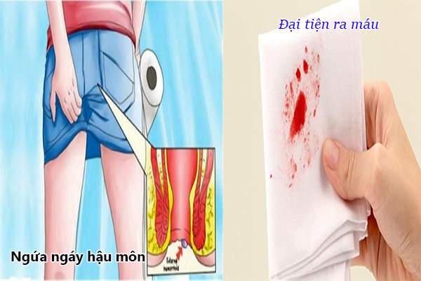 Trieu chung cua benh tri