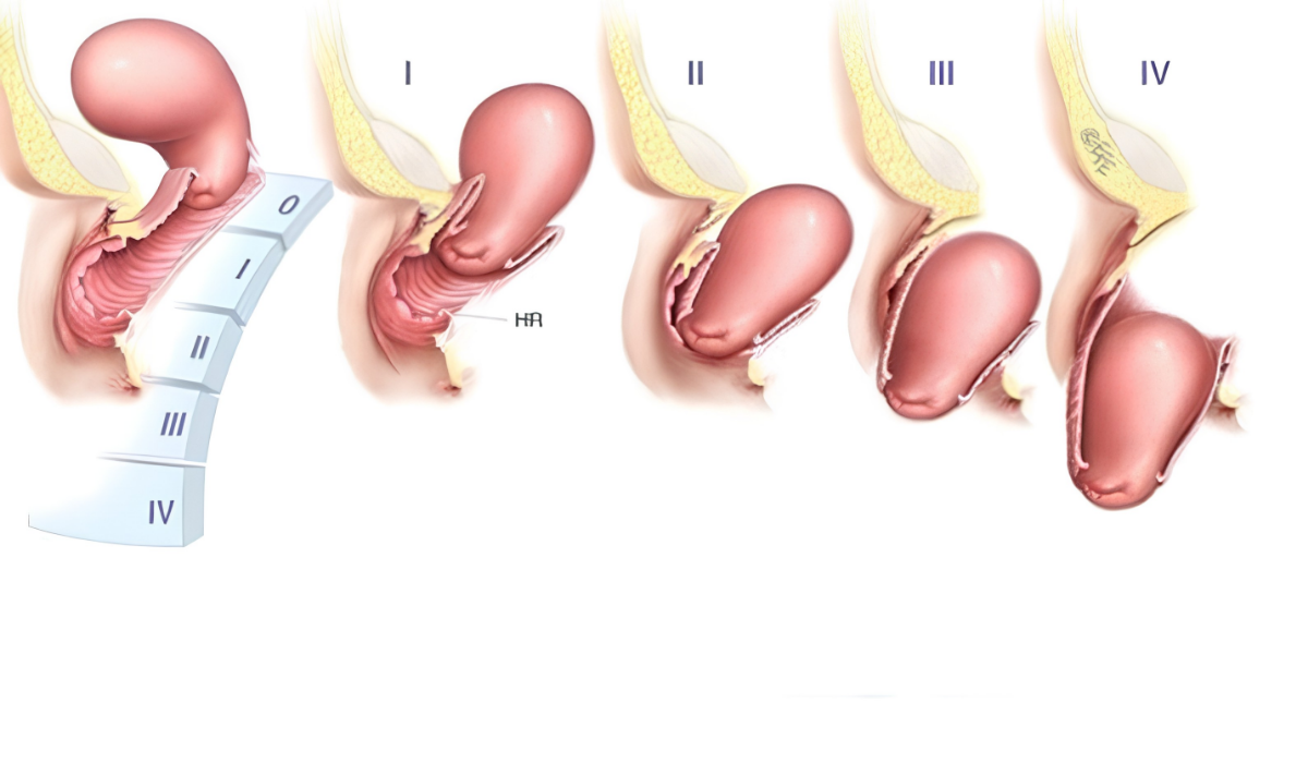 Hình Ảnh Sa Tử Cung Sau Sinh: Dấu Hiệu Nhận Biết Và Cách Điều Trị