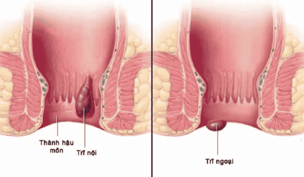 Top 4 Địa Chỉ Cắt Trĩ Bạc Liêu Uy Tín
