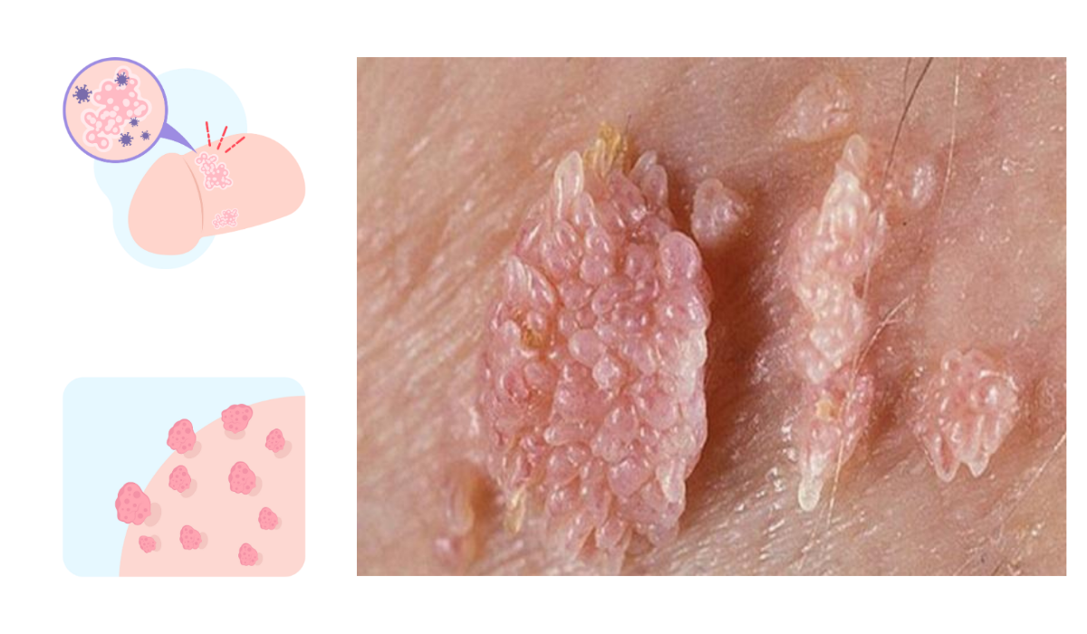 Top 4 Địa Chỉ Điều Trị Sùi Mào Gà Bạc Liêu Uy Tín