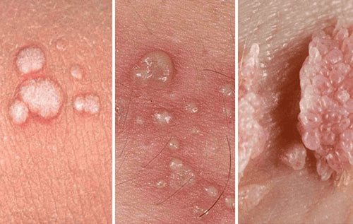 Top 5 Địa Chỉ Điều Trị Sùi Mào Gà Cần Thơ