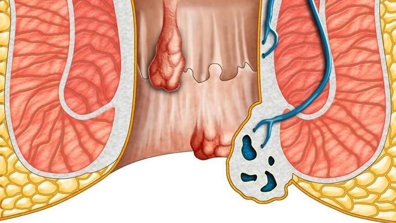 5 Địa Chỉ Khám Chữa Bệnh Trĩ Cần Thơ Uy Tín Bác Sĩ Giỏi