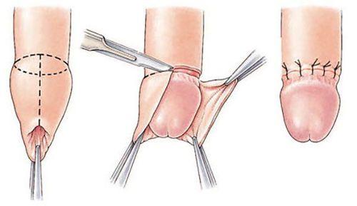 Top 5 Địa Chỉ Cắt Bao Quy Đầu Cần Thơ Uy Tín