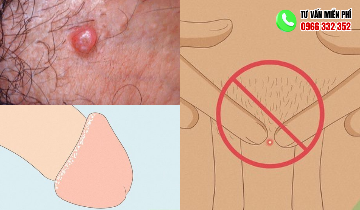 Hình Ảnh Nổi Mụn Ở Vùng Kín Nam Giới Và Các Dạng Phổ Biến