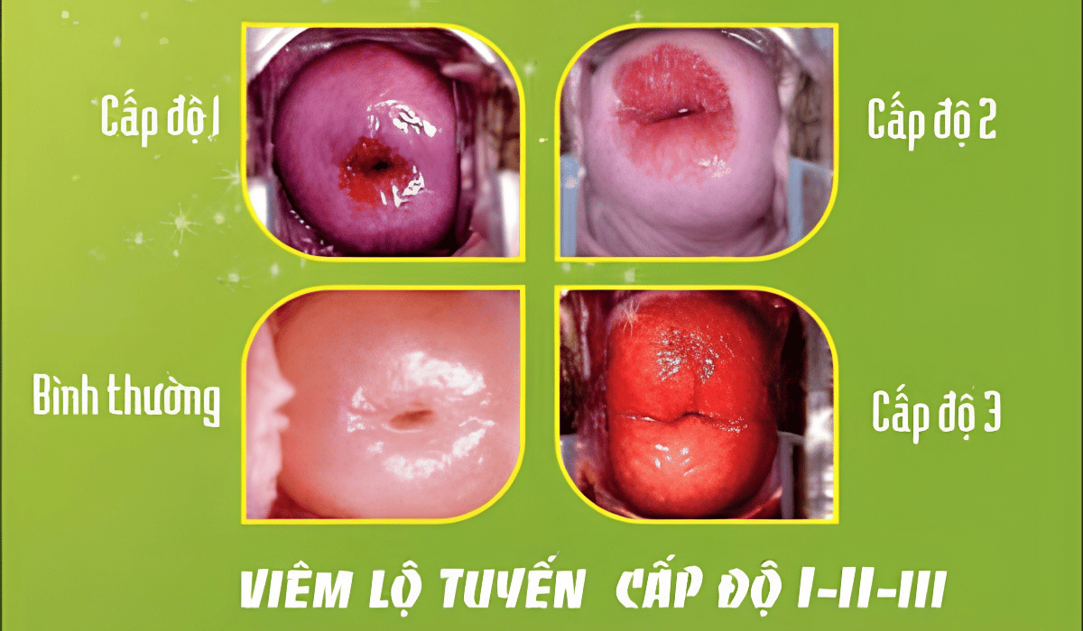 Hình Ảnh Viêm Lộ Tuyến Cổ Tử Cung Qua Từng Cấp Độ Chi Tiết