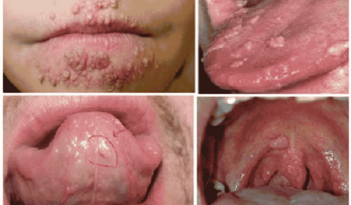 Top 4 Địa Chỉ Điều Trị Sùi Mào Gà Cà Mau Uy Tín