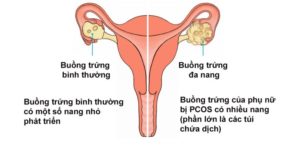 kinh nguyet khong deu trieu chung khong nen bo qua