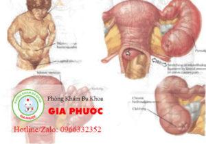 viem vung chau trieu chung va cach dieu tri