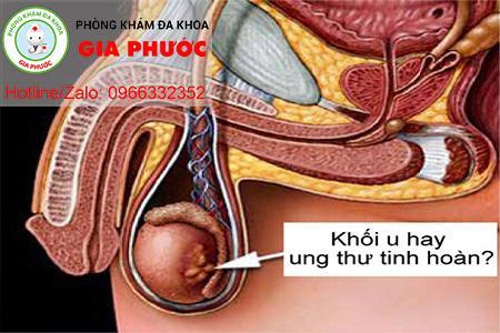 bien chung ung thu tinh hoan