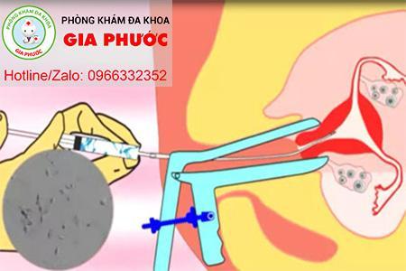 bom tinh trung vao trong buong tu cung