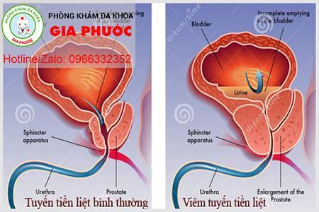 dau hieu cua viem tuyen tien liet
