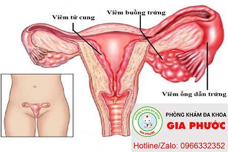 viem nhiem cac vung lan can lay lan sang viem buong trưng