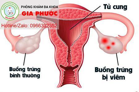 hinh-anh-buong-trung-bi-viem