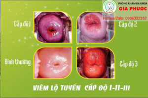viem lo tuyen co tu cung trieu chung va cach dieu tri