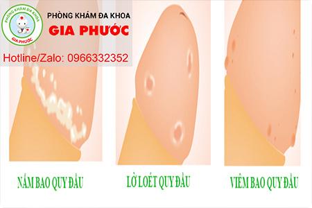 viem bao quy dau dan den viem tinh hoan