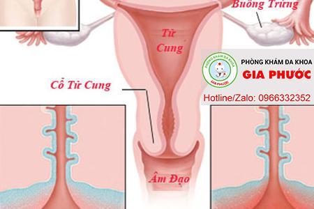 Viem co tu cung giai doan man tinh