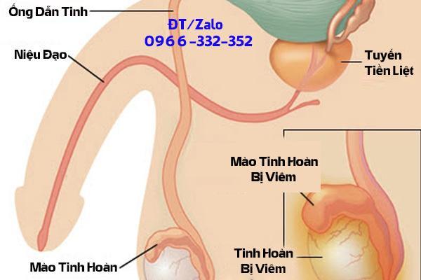 viêm mào tinh hoàn