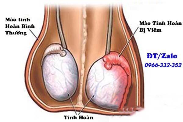 vi&ecirc;m m&agrave;o tinh ho&agrave;n