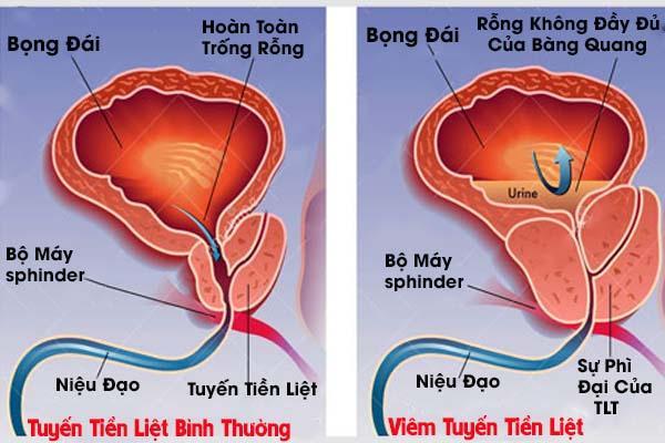 viêm tuyến tiền liệt