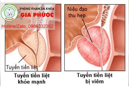 muc do benh quyet dinh den chi phi dieu tri