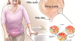 nhung dieu can biet ve benh viem nieu dao