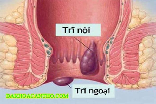 Benh tri hon hop
