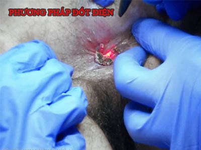 Chua sui mao ga bang dot dien