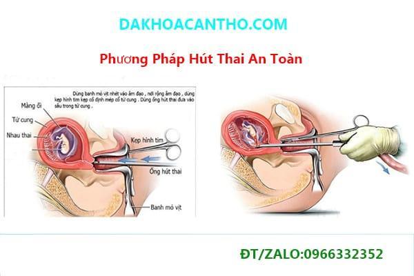 Phương pháp phá thai an toàn bằng cách hút thai