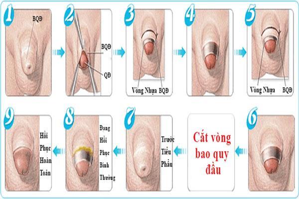 Quy trinh cat bao quy dau