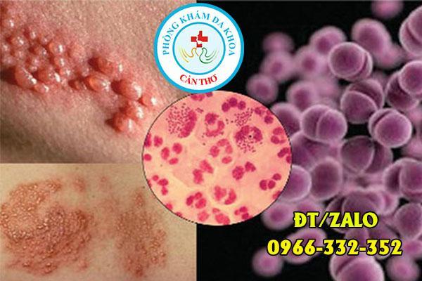 bệnh lậu ở nữ giới