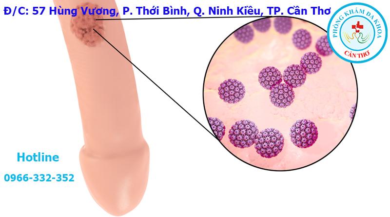 Sùi Mào Gà Ở Nam Giới Có Nguy Hiểm Không?