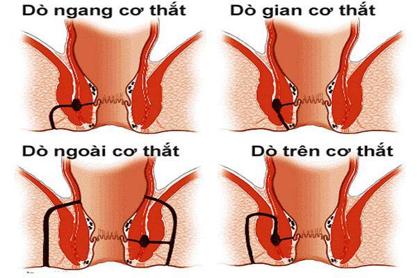 Rò hậu môn chia làm 4 loại