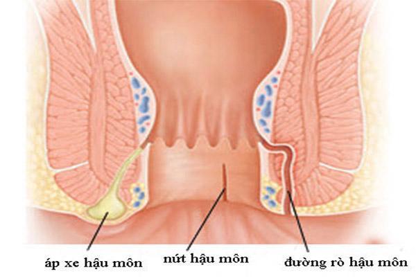 Hình ảnh bệnh rò hậu môn