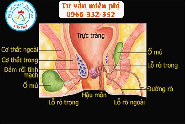 Hình ảnh hậu môn có mụn mủ 