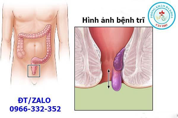 hình ảnh bệnh trĩ