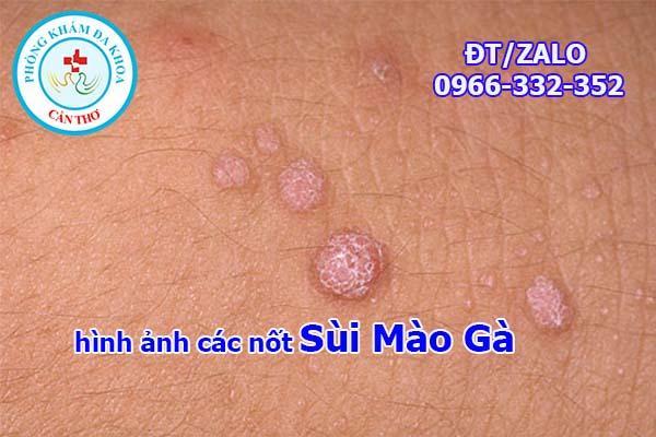 hình ảnh các nốt sùi mào gà