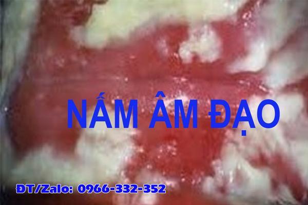 nguyên nhân viêm phụ khoa