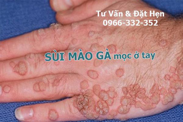 sùi mào gà mọc ở tay