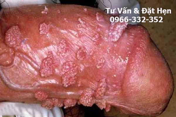 sùi mào gà ở nam