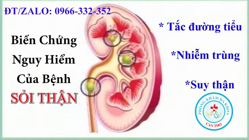Tổng Hợp Một Số Bài Thuốc Nam Chữa Sỏi Thận