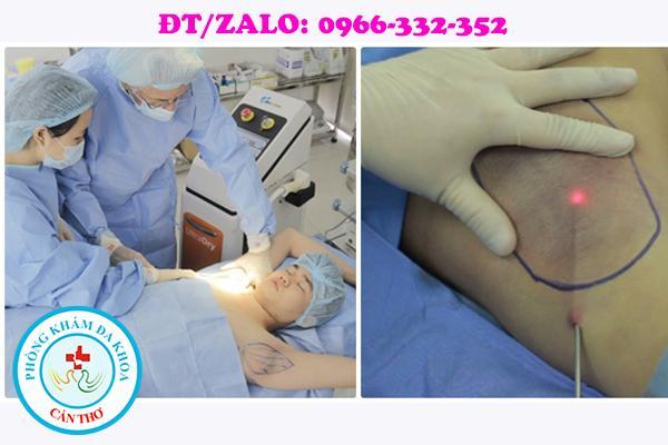 trị hôi nách bằng công nghệ mới