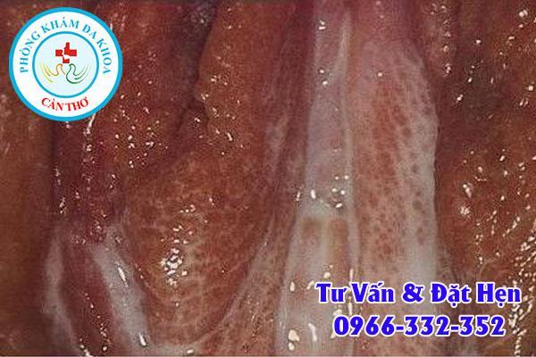 triệu chứng bệnh lậu ở nữ giới