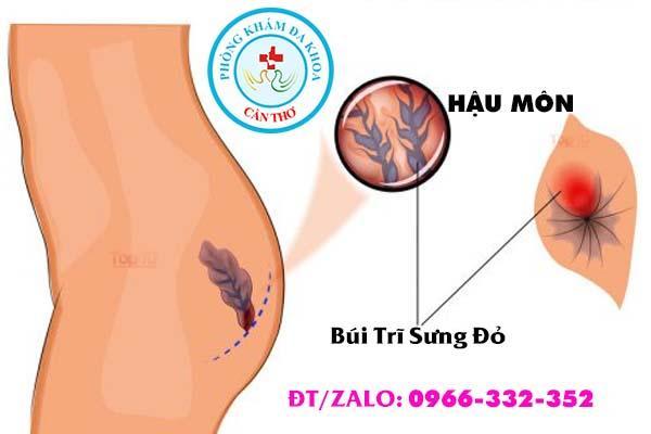 triệu chứng nhận biết bệnh trĩ