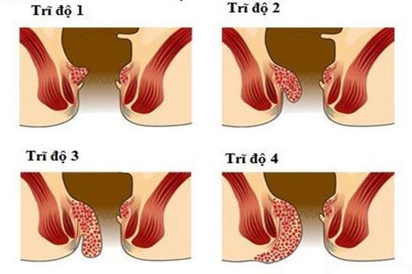 Triệu chứng trị bệnh trĩ nội